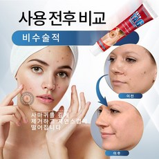 빠르고 효과적인 크림 퓨 순율 크림 율무 편평사마귀 얼굴 사마귀, 1개, 20g