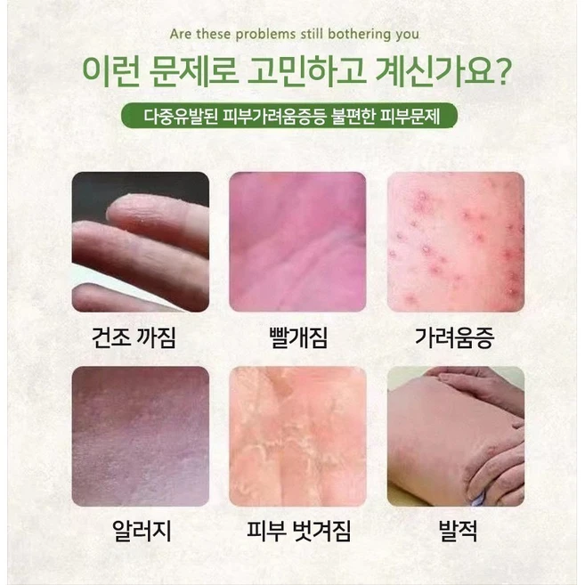 [일본 수입] 천연 순수 식물 추출 완화 화폐상습진/두드러기/피부 가려움증/한포진/피부건조/알레르기 발포/ 등의 w001, 2개, 20g