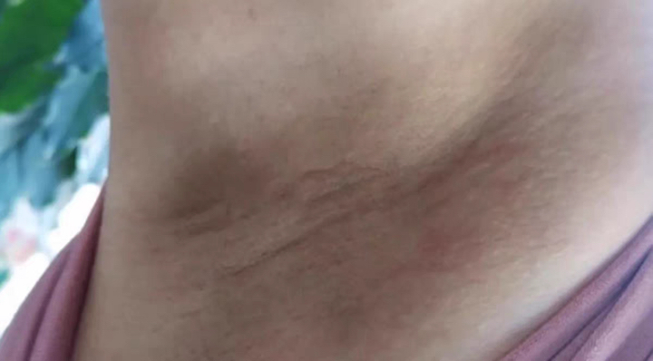 국내출하 EEHOE 1 1 미백크림 겨드랑이 팔꿈치 겨드랑이 색소침착