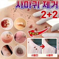 [당일배송] 미국기술 편평 제거 펜 피부 치료 제거 펜 손 발 치료 제거 액 크림 피부관리, 1개, 3ml