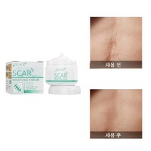 EELHOE 흉터제거연고 피부 흉터 치료 켈로이드성 화상 흉터, 30ml, 1