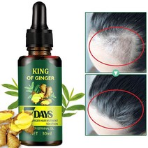 KING 정수리 탈모 원형탈모 탈모약 탈모병원 생강영양액 30ml