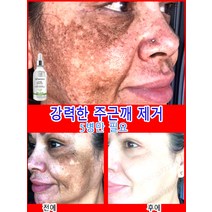 스팟 제거 크림 기미 얼굴 반점 다크 스팟 제거제, [04]