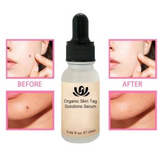 20ML Organic Tags Solutions 에센셜 오일 스킨 태그 리페어 솔루션으로 세럼 몰레 워터 Painless Face Wart Mole Freckle TSLM2|, 1개, CHINA