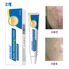 HEALMUSZ 여드름 연고 좁쌀여드름 긴급구호 20g A-11, 2개, 20ml