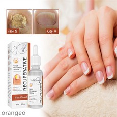 발톱무좀레이저기기