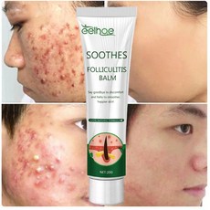 여드름 연고 여드름 색소침착 흉터 치료 연고 여드름 방지 미백 크림, 20ml, 2개