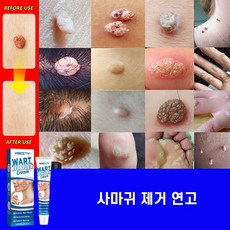 치료 제거연고 제거 스킨 제거 크림, 1개, 20g, 20g