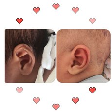 추천4신생아귀교정기