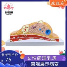 해부 모형 인체 동물 병원 과학 교육 유선병변모델 여성유방모형 유방병변모델 인체조직 장기해부 몰드, 01 병변유방모형