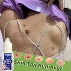 생식기쥐젖