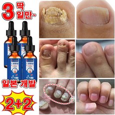 일본 개발 1/1+1 손톱 발톱 무좀 케어 앰플 발톱 영양제 발톱 관리 제거 문제성 발톱 100% 제거, 4개, 30ml