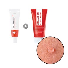 눈가비립종셀프제거