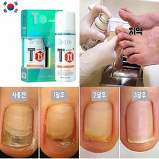 발톱무좀연고