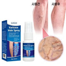 정맥 마사지 스프레이 혈관염 부종 통증 완화 하지정맥류 다리부종 정맥류 스프레이, 2개, 30ml