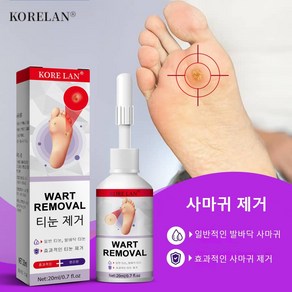 [국내배송/당일배송] 1+1 발가락 발바닥 제거 발가락 연고, 2개, 20ml