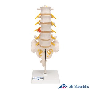 3B Scientific 인체모형 A76/5 후외측 배측방 디스크 요추 Doso-Lateal Polapsed, 1개