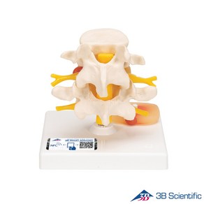 3B Scientific 인체모형 A76 추간판 탈출증 요추 Lumba with Polapsed, 1개