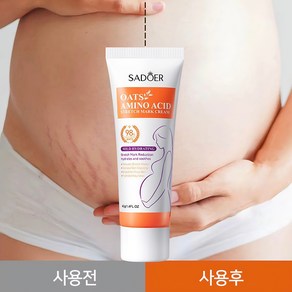 SADOER스트레치 마크 크림-미국 FDA 인증 획득 주로 튼살을 수리합니다 뚱뚱한 선 엄마들이 완벽한 피부를 가지도록 해주세요