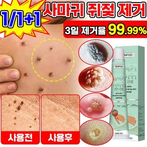 [빠른배송] 사마귀 연고 비립종 눈밑 지방 제거 크림 피부 여드름 치료 연고, 2개, 20g