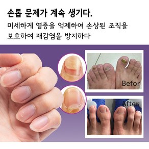 HANLU [빠른배송] 발톱진균 리페어 연고 발톱진균제 갑진균병 살균