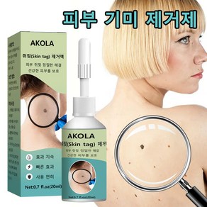 AKOLA [국내배송] 피부 액상 사마귀 치료제 피부 염증 완화 크림, 1개, 20ml