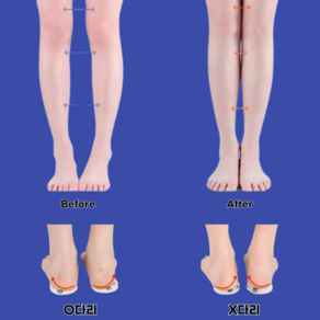 코지치 오다리 휜다리 아치 보호 자세교정 깔창