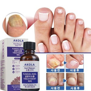 Nail repair Essence 네일 트리트먼트 영양액 트리트먼트 로션 손톱 발톱 전용액, 2개, 10ml