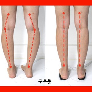 [1+1] 오다리 깔창 x다리 오다리용 팔자걸음 휜다리 걸음걸이 교정 2켤레, 2세트