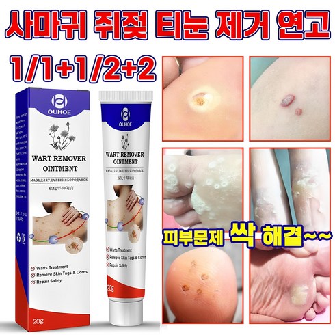 nekvnro 편평제거 - [국내배송] 연고 사마귀 제거제 얼굴 점빼기 피부 치료 크림 포장증정, 1개, 20g