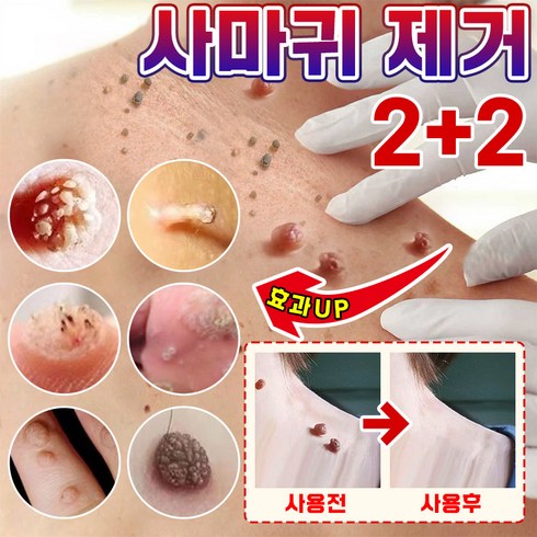 사마귀연고 - [당일배송] 미국기술 편평 제거 펜 피부 치료 제거 펜 손 발 치료 제거 액 크림 피부관리, 1개, 3ml