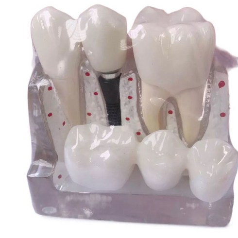 치아 임플란트 모형 치과 병리학 모델 구강 교육 해부학 의사 간호사 보건, 하얀색