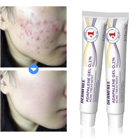 dermfree 리페어 크림 - DERMFREE 여드름 제거 리페어 크림 스팟 케어 문제피부 자국 모공 진정 피지케어 연고, 2개, 20g
