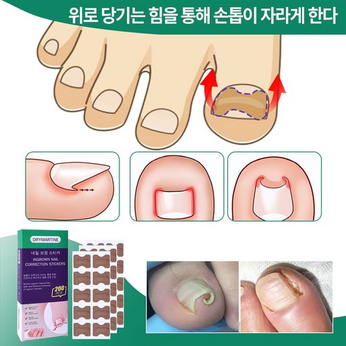 내성발톱 - DRYMARTINE 내성발톱교정테이프 발톱 테이프 200pcs, 200개