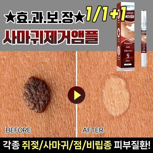 쥐젖제거크림 - 미국기술 1/1+1 손 발 제거 연고 얼굴 목 피부 제거 펜, 3ml, 2개