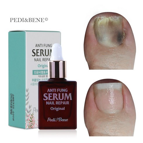 페디베네 안티펑 오리지날, [801-3]10ml 1개, 0.01l