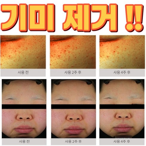 [피부과용] 특허 기미잡티 검버섯크림 멜라논 크림 앰플 검버섯제거연고 반점 제거 색소침착 기능성 인증, 기미잡티 제거 크림1개, 1개