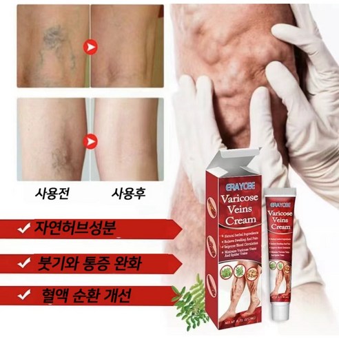 [치료효과 99.99%] 빠른 치료 | 정맥류 | 혈관염 | 정맥류 통증 | 하지정맥류, 1개