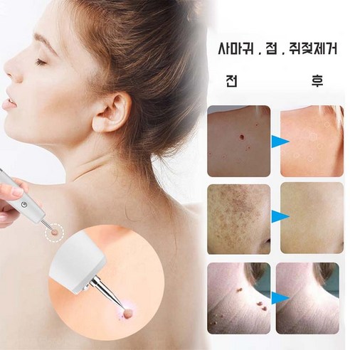 플라즈마펜으로 깨끗한 피부, 자신감을 되찾으세요!
