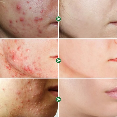 여드름 고민, 이 크림으로 해결하세요!