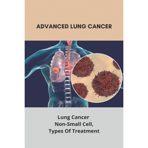 Advanced Lung Cancer: Lung Cancer - Non-Small Cell Types Of Treatment: Lung Cancer Survival Rate Paperback, Independently Published, English, 9798738354786