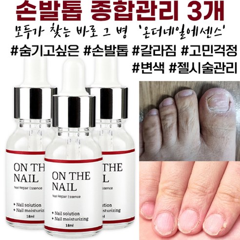 온더네일 에센스 네일 트리트먼트 손발톱 손톱 발톱 리페어 에센스 nail repair nail fungus treatment, 18ml, 1개