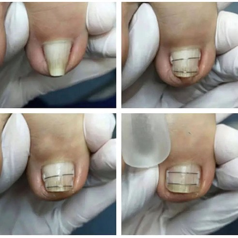 발톱 케어의 새로운 기준