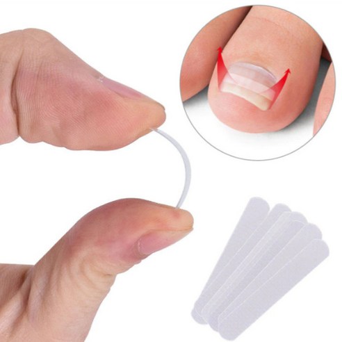 내성발톱 교정 클립 세트