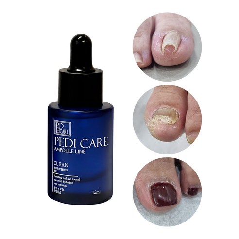 묵은 발톱 고민 해결, 자신감을 되찾아주는 페디 케어 앰플