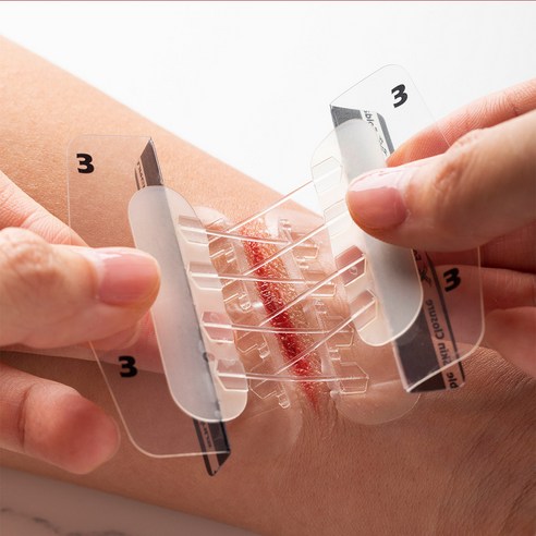 흉터 걱정 없이 빠르고 깔끔하게! 서지너스 응급 상처 봉합밴드로 상처 고민 끝!