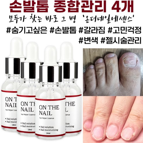 온더네일 에센스 네일 트리트먼트 손발톱 손톱 발톱 리페어 에센스 nail repair nail fungus treatment, 18ml, 1개