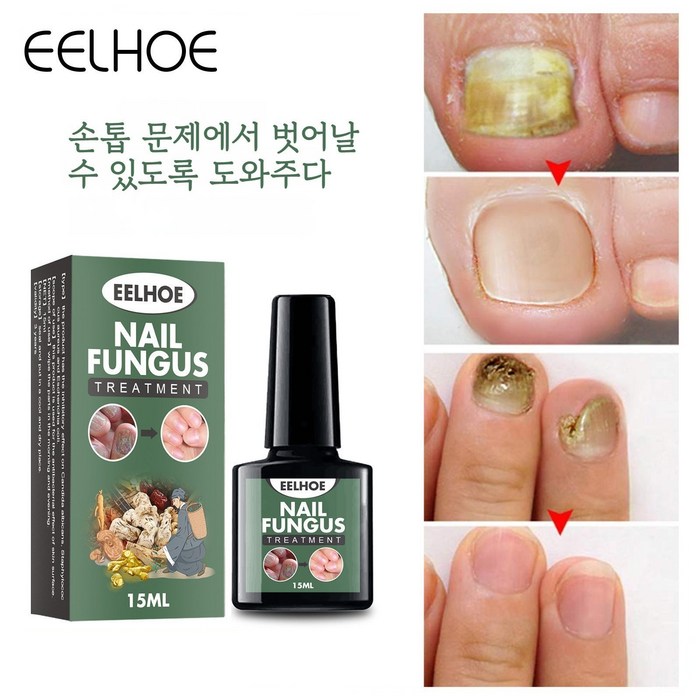 EELHOE 1+1 발톱무좀 발톱무좀치료 발톱 무좀약 진균 리페어 에센스, 15ml*2 대표 이미지 - 발톱깎이 추천