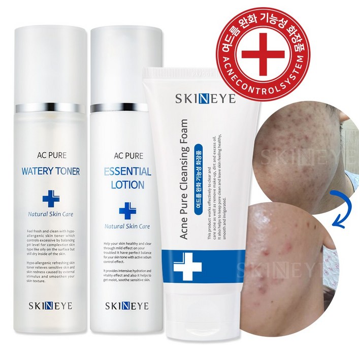 스킨아이 AC 퓨어 워터리 토너  에센셜 로션 아크네 청소년 여드름 클렌징 폼 SET 여드름 기초 스킨케어 3종 SET, 1세트